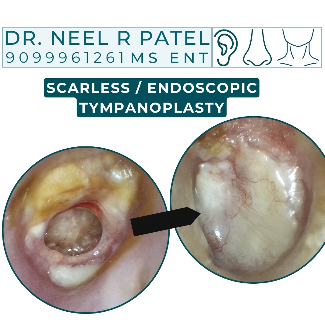 Ear drum perforation repair scarless endoscopic